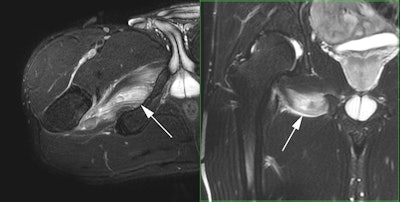 Professional tennis player with acute onset right groin pain during a match. Axial and coronal fat-saturated T2-weighted MR images demonstrate an acute injury of the right obturator externus muscle with a small focal hematoma. All images courtesy of Dr. Ara Kassarjian.