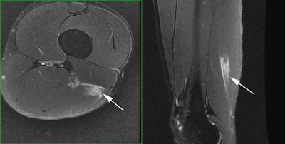 Professional tennis player who experienced acute pain along the back of his left thigh during a match. Axial and sagittal fat-saturated T2-weighted MR images demonstrate an acute injury to the distal fibers of the long head of the biceps femoris near its junction with the short head biceps femoris.