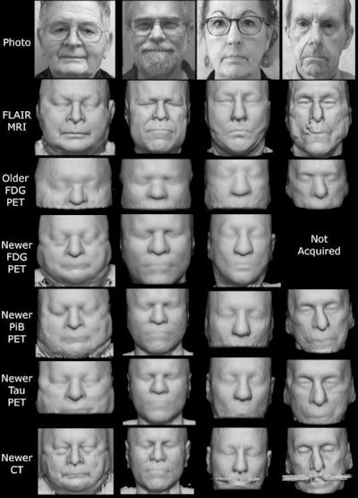 Example face reconstructions from PET and CT, for visual comparison with photographs and MRI. PET scans from the newer model of clinical PET/CT scanner showed many identifiable features, across all tracers. CT scans (from PET/CT) were also highly identifiable despite some dental artifacts and face mask nose bridges. PET from older-generation scanners had lower quality and a smaller field of view but retained some identifiable features. These participants specifically consented to allow publication of their photographs and face reconstructions. Note that although positioning and head restraints in the scanner distort the lower face in the facial reconstructions, the brow ridge, which is a dominant feature in facial recognition, is minimally affected. Image courtesy of NeuroImage.