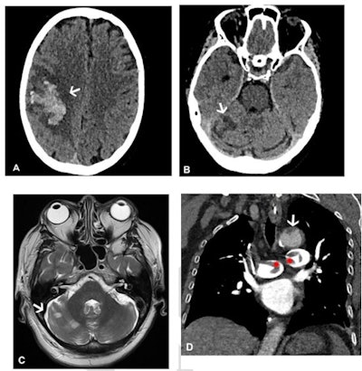 Images in a 64-year-old woman who presented with confusion and collapse and was diagnosed with intracranial hemorrhage associated with cerebral venous sinus thrombosis secondary to VITT. (A) Axial unenhanced head CT image demonstrates a large right parietal lobe intraparenchymal hemorrhage and (B) bilateral infarcts in the cerebellum confirmed on axial brain T2-weighted MRI. (D) CT pulmonary angiogram coronal reformatted image shows eccentric mural thrombus within the aorta (white arrow) and large central saddle embolus (red asterisks). Images and caption courtesy of the RSNA.
