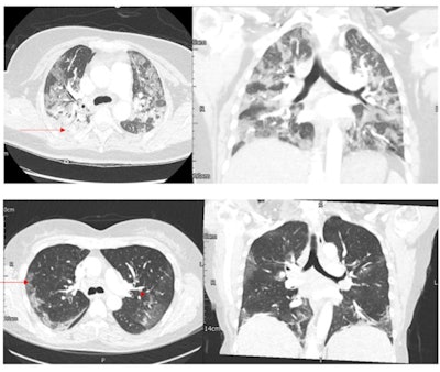 (Top two) Axial and coronal CT images on lung window in a 33-year-old woman with delta SARS-CoV-2 pneumonia without critical care admission. Chest CT images show bilateral multifocal patchy ground-glass opacities and consolidation with both central and peripheral distribution, with more confluent consolidation in the posterior segment of right upper lobe (arrow), with overall global mean CT severity score of 23. Bronchial wall thickening is absent. (Bottom two) Axial and coronal CT images on lung window in a 59-year-old woman with omicron SARS-CoV-2 pneumonia without critical care admission. Chest CT images show bilateral multifocal peripheral ground-glass opacities (arrow) with predominantly peripheral distribution, with overall global mean CT severity score of 10. Bronchial wall thickening is present (arrowhead). Images and caption courtesy of the RSNA.
