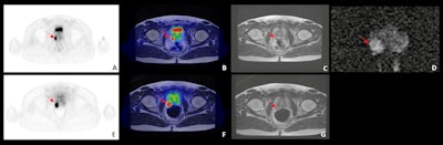 Example of an intraprostatic concordant finding in a 53-year-old patient who underwent dual-tracer PET/MRI for prostate cancer staging. (A) Transaxial Ga-68 PSMA PET. (B) Ga-68 PSMA PET/MRI. (C) Axial T2-weighted sequence. (D) Diffusion-weighted imaging (b = 1,400) of the prostate. (E) Transaxial Ga-68 DOTA-RM2 PET. (F) Ga-68 DOTA-RM2 PET/MRI. (G) Axial T2-weighted sequence. Red arrows indicate pathological prostate findings. Courtesy of Paola Scifo, PhD, and ISMRM.