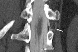 2022 06 28 17 57 7094 2022 04 18 17 43 5921 2022 04 18 Csf Venous Fistula 400