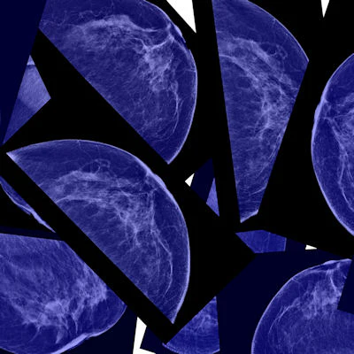 Mammography self-compression yields similar image quality ...