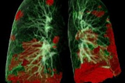 2020 11 19 16 46 1912 Ct Lung Damage Covid 19 400