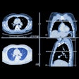 2021 09 13 18 08 1880 Lung Ct Images 400