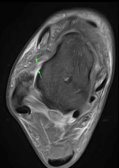 Axial fat-suppressed proton density 3-tesla MRI of the right ankle demonstrates a grade 1/2 tear of the anterior talofibular ligament (ATFL).
