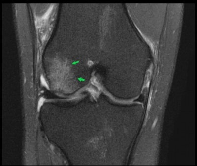 Coronal fat-saturated proton density 3-tesla MRI of the right knee shows an acute pivot shift injury with an acute lateral condylar bone contusion. This is highly indicative of an associated anterior cruciate ligament (ACL) tear.