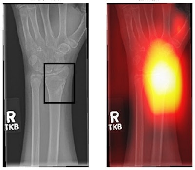 (Left) Area with fracture (in the box). This may not be easily picked up by an inexperienced radiographer. (Right) An AI-generated heatmap, directing the radiographer to check the area. Figure courtesy of Clare Rainey and MURA dataset.