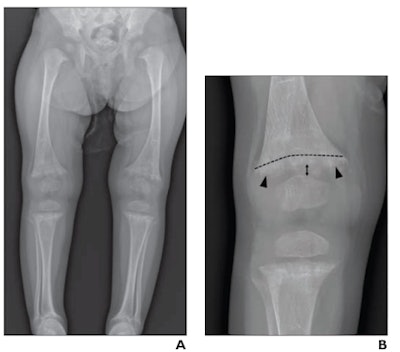 (A, B) a 21-month-old girl with rickets and vitamin D level of 5 ng/mL. (A) Long-leg bilateral lower extremity radiograph. (B) Edited radiograph of the right knee shows cupping (curved dotted line), fraying (arrowheads), and increased physeal widening (double-head arrow) in the distal femur, with similar findings in the proximal tibia and fibula (not annotated), all consistent with rickets; radiograph shows no signs of classic metaphyseal lesions. All eight radiologists correctly interpreted radiograph as showing rickets with moderate or high confidence. Images courtesy of the American Journal of Roentgenology.