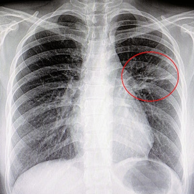 2022 07 12 21 16 5219 Lung Pneumonia Cad 400