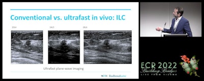 Ultrafast ultrasound imaging will play a more prominent role in supplemental breast cancer screening in 2025, said Dr. Chris de Korte from Radboud University Medical Center in the Netherlands. The ultrasound 'revolution' de Korte said is happening will eventually result in combining 3D, functional, and contrast-enhanced techniques.
