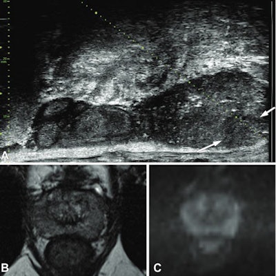 Images show a 49-year-old man with prostate-specific antigen (PSA) level of 8.26 ng/mL. (A) Prostate risk identification was performed with microultrasound on a category 4 nodule (arrows) in the left midgland peripheral zone. The lesion was not identified at multiparametric MRI. Corresponding T2-weighted (B) and high-b-value diffusion-weighted (C) MRI scans are also shown. Targeted biopsy revealed grade group 2 disease. Images courtesy of the RSNA.