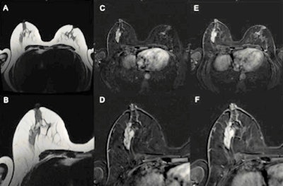 B2 lesion rated BI-RADS 4/5 by experts and benign using the Kaiser score. T2 turbo-spin echo (A), early (C) and late (E) postcontrast T1 with fat suppression, as well as corresponding magnifications of the right breast (B, D, F). This lesion was rated as MR BI-RADS 4 or 5 by the experts. Applying the Kaiser score to this mass lesion without spiculations, persistent enhancement, and irregular margins gives a Kaiser score of 3, which is a benign result corresponding to a BI-RADS 2/3. Histologic verification showed tumor-free mammary parenchyma with low-grade pseudoangiomatous stromal changes, B2. (All figures courtesy of Dr. Nina Pötsch and European Radiology)