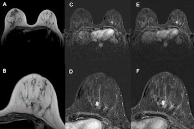 Fibroadenoma rated BI-RADS 4/5 by experts and benign using the Kaiser score. T2 turbo-spin echo (A), early (C), and late (E) postcontrast T1 with fat suppression, as well as corresponding magnifications of the left breast (B, D, F). This lesion was rated as MR BI-RADS 4 or 5 by the experts. Applying the Kaiser score to this mass lesion without spiculations, plateau enhancement, and circumscribed margins gives a Kaiser score of 2, which is a benign result corresponding to a BI-RADS 2/3. Histologic verification showed a fibroadenoma, B2.