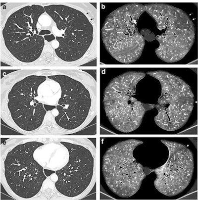 DECT angiographic exam obtained in a 55-year-old female nonsmoker with limited cutaneous systemic sclerosis diagnosed 24 years earlier (170 cm, 50 kg). Stable diffusing capacity of the lung alteration over two years. Paired lung and perfusion images obtained at the level of the upper (a, b), mid (c, d), and lower (e, f) lung zones. Absence of CT features of interstitial lung disease on lung images (a, c, e). Bilateral perfusion defects, combining patchy defects in both lungs (b, d, f), marked subpleural hypoperfusion in the lingula and left lower lobe (arrowhead; d, f) and a large triangular, pulmonary embolism-type perfusion defect (arrows; b) in the left upper lobe with reduced number of vascular sections in the corresponding lung image (arrows, a). No morphologic CT features of acute and/or chronic pulmonary embolism. Note the presence of marked esophageal dilatation. (All figures courtesy of Antoine Dupont, Prof. Martine Remy-Jardin and European Radiology).