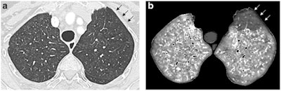 Dual-energy CT angiographic examination obtained in an 85-year-old female with limited cutaneous systemic sclerosis diagnosed 18 years earlier (159 cm, 60 kg), precapillary pulmonary hypertension recognized four years before this exam, and suspicion of pulmonary veno-occlusive disease or pulmonary capillary hemangiomatosis. Paired lung and perfusion images obtained at the level of the upper lobes (a, b), showing profuse, ill-defined lung micronodules in both lungs (a), highly suggestive of pulmonary veno-occlusive disease or pulmonary capillary hemangiomatosis, and a pulmonary embolism-type perfusion defect in the anterior segment of the left upper lobe (arrows, b). This perfusion defect was the only perfusion defect, seen in the absence of CT features of acute and/or chronic pulmonary embolism.