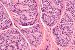 2019 12 13 19 51 1879 Carcinoid Neuroendocrine Tumor 400