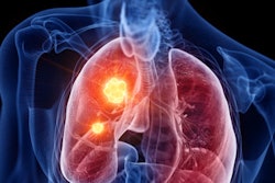2020 07 22 19 19 3936 Lung Cancer Hotspot 400