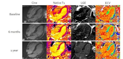 Improvement in cardiac amyloidosis demonstrated by cardiovascular MR (CMR) extracellular volume mapping (ECV) for amyloid. Baseline scan on top row; after six months of chemotherapy mid row; and one year after chemotherapy bottom row. There are progressive reductions in CMR (identified as T1 in column two) and ECV (column four) over the course of the treatment. Image and caption courtesy of the University College London.