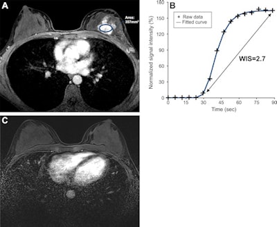 Ultrafast breast DCE-MRI scans in a 47-year-old woman who underwent neoadjuvant chemotherapy for hormone receptor-negative and HER2-positive cancer. (A) Axial last-phase ultrafast T1-enhanced DCE-MRI scan acquired before therapy, with the largest region of interest placed over the lesion (oval); (B) wash-in slope on the initial ultrafast time-signal intensity curve of the breast cancer; and (C) axial postcontrast T1-enhanced standard DCE-MRI scan acquired after therapy. The tumor manifested as a 4-cm nonmass enhancement in the left breast. The time-signal intensity curve at initial ultrafast DCE-MRI shows a high wash-in slope of 2.7% per second. A DCE-MRI scan acquired after therapy showed no residual enhancement, and histopathologic examination revealed no invasive residual cancer. Images courtesy of RSNA.