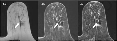 A 63-year-old patient with invasive ductal carcinoma marked by an Ultraclip metallic marker and treated with neoadjuvant chemotherapy underwent a preoperative 1.5T MRI exam with T2-weighted, 3D T1-weighted VIBE before and after contrast media injection. Metallic marker is responsible for a hypointense artifact with hyperintense halo more important with fat saturation than Dixon sequences as expected. Because of this artifact, the patient was considered Radiological Complete Response (rCR) with low diagnostic confidence from both readers, but residual tumor was detected in final pathology results.
