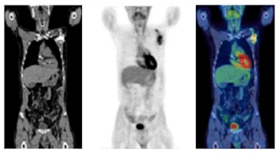 F-18 FDG PET/CT in the assessment of an infected cardiac pacemaker. (All figures courtesy of RCR)