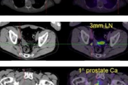 2022 08 05 17 42 1639 2022 08 08 Ga Labeled Psma Ligand Pet Ct 400