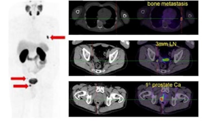 Gallium-68 (Ga-68)-labeled prostate-specific membrane antigen ligand PET/CT in prostate cancer.