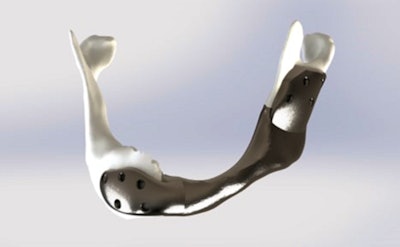 The Netherlands Cancer Institute successfully carried out the first operation with a custom 3D-printed titanium lower jaw. Image courtesy of Mobius 3D Technology.