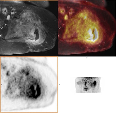 A 43-year-old male with a 20-year-old complex bone injury. The proximal femur was destructed and soft tissue around the bone showed high FDG uptake. PET and MRI conclusions were consistently positive for osteomyelitis. In this case, the extent of the infection based on PET/MRI guided the clinician planning surgery. The presence of osteomyelitis was confirmed by both intraoperative cultures and follow-up. Image courtesy of the European Journal of Hybrid Imaging.
