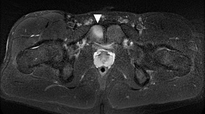 Olympic athlete with pubic stress reaction. Image courtesy of BMC Musculoskeletal Disorders.