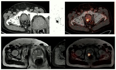 PET/MRI is significantly more effective than PET/CT for imaging prostate cancer prior to surgery, Umutlu said.