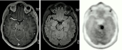 The PET component of PET/MRI can reveal brain tumors that may go undetected by MRI alone.