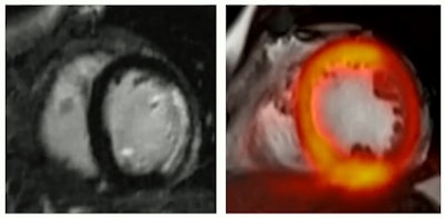 Hybrid late-enhancement MRI and PET imaging can help diagnose acute myocardial infarction.