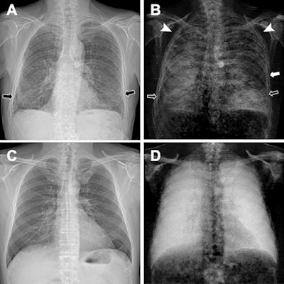 Figure 2: (A, C) Conventional attenuation-based chest x-rays and (B, D) dark-field chest x-rays in an 83-year-old man diagnosed with combined pulmonary fibrosis and emphysema (upper row) and a healthy 33-year-old man (lower row). Image courtesy of Radiology: Cardiothoracic Imaging.