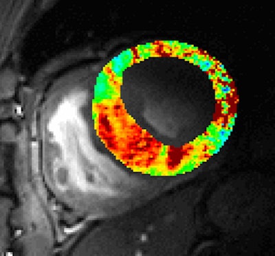 Cardiac T2* map acquired at 7 tesla. The image shows a short axis view of the heart of a patient with hypertrophic cardiomyopathy. Red indicates a prolongation in T2* which is pronounced for myocardial regions with wall thickening. Courtesy of Prof. Thoralf Niendorf.