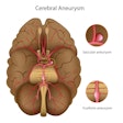 2021 05 18 17 30 6020 Cerebral Aneurysm 400