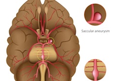 2021 05 18 17 30 6020 Cerebral Aneurysm 400