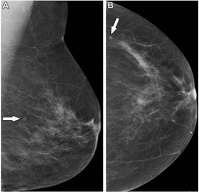 Mammograms in a 50-year-old woman undergoing her first screening mammographic examination show a 3-mm mass (arrow) in the left breast on the (A) mediolateral oblique and the (B) craniocaudal view. It was not recalled by the radiologist who read the mammogram first but was recalled by the radiographer who read the image second. The case was recalled for further assessment after arbitration by a third reader. Ultrasound-guided biopsy showed a 3-mm histologic grade 1 ductal carcinoma. Images courtesy of RSNA.