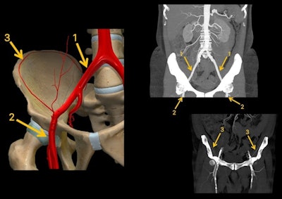 Anatomy of external iliac artery (1), femoral artery (2), and deep circumflex iliac artery (3). All figures courtesy of Dr. Silvia CayĂłn Somacarrera and colleagues, presented at ECR 2022.