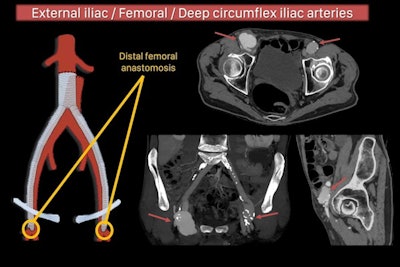 Bilateral femoral artery pseudoaneurysm following aortobifemoral bypass surgery. Pseudoaneurysms constitute an uncommon complication (less than 3% of patients) of aortic reconstructive surgery. They result from partial or total disruption of the anastomosis between an artery and a vascular graft, creating a pulsatile hematoma with fibrous encapsulation. The femoral artery is the most common site involved, accounting for about 75% of cases, and it usually occurs around the anastomotic site of the femoral bypass.