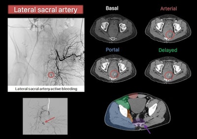 Active bleeding in the lateral sacral artery.