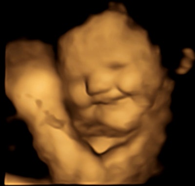 Researchers from Durham University examined fetal reactions to flavor capsules ingested by their mothers via 4D ultrasound. Here, a 4D image of a fetus shows a laughter-face reaction after being exposed to the carrot flavor.