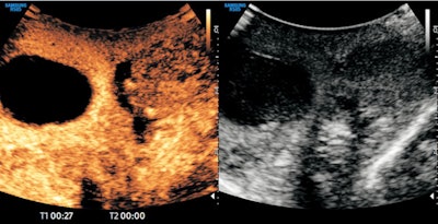 Contrast-enhanced ultrasound demonstrates testicular infarction in a case of spermatic cord torsion. Image courtesy of Prof. Paul Sidhu.