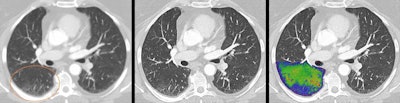 Lung images of a post-COVID patient with photon-counting CT. Photon-counting allows for simultaneous acquisition and visualization of detailed structures (middle image) combined with functional information (image on the right). For comparison, an image acquired with conventional CT technology (on the left). Courtesy of Prof. Dr. Jiří Ferda, PhD, University Hospital Plzen, Czech Republic.