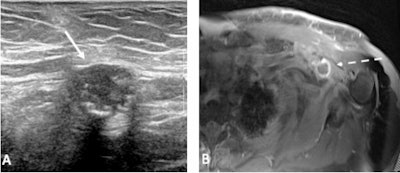 (A) Left axillary ultrasound shows a round, hypoechoic mass (solid arrow) with echogenic foci that are likely to represent calcifications. (B) Axial T1-weighted fat-suppressed postcontrast MRI reveals a rim-enhancing soft-tissue mass (dashed arrow) in the left axilla. Pathology revealed spindle cell sarcoma. Figure courtesy of Dr. Tiffany L. Chan and Prof. Cheryce Poon Fischer, presented at ECR 2022.