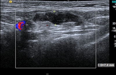 A 37-year-old woman with bilateral subpectoral implants presented to breast clinic at the Royal Free Hospital with a two-week history of palpable left axillary lump. Grey-scale ultrasound of the left axilla revealed a lymph node with cortical thickening measuring up to 7 mm. An ultrasound-guided core biopsy of the lymph node was performed, which confirmed reactive changes only. The patient had received the COVID-19 vaccine in the left arm approximately a week prior to the lymph node becoming clinically palpable. Image courtesy of Dr. Adam Brown and colleagues, presented at ECR 2022.