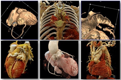 SERAM is highlighting the clinical value of cardiac imaging techniques in the wake of sharp increases in the volume of examinations. Figure courtesy of SERAM.