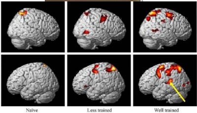 Brain areas activated by just looking (without sound) at a pianist playing a musical piece. Well-trained musicians activate a network of regions connecting visual, auditory, and motor areas, such as the inferior frontal gyrus and in experienced pianists, mainly the planum temporale. Figure courtesy of Prof. Denis Le Bihan reprinted in his book 'Le cerveau de cristal' (Odile Jacob Ed.) with permission from Hasegawa et al. Cogn Brain Res 2004, 20, 510-518).
